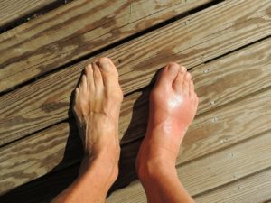 swollen feet