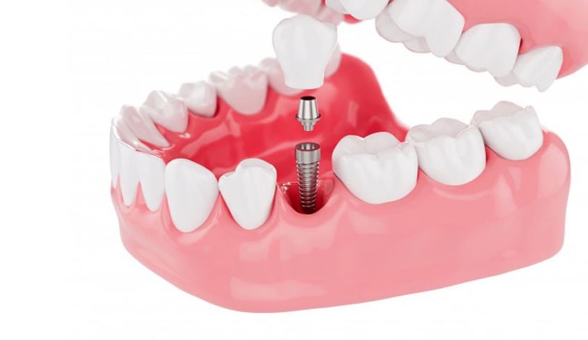 dental implant
