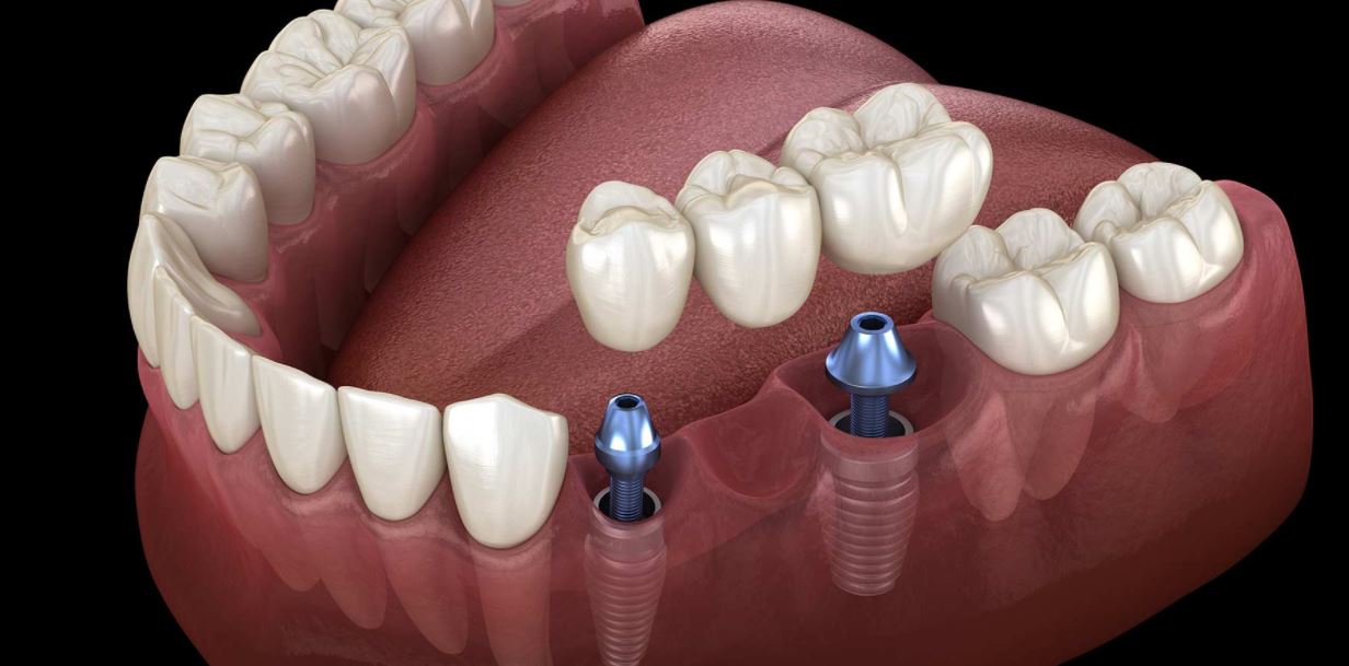 cosmetic dental implant