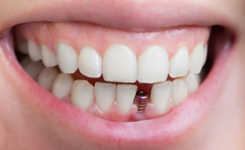 tooth implant