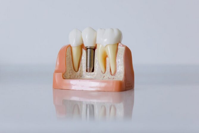 implants
