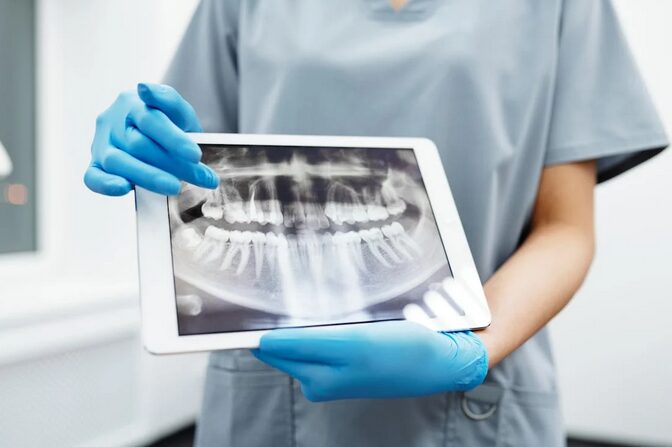 root canal